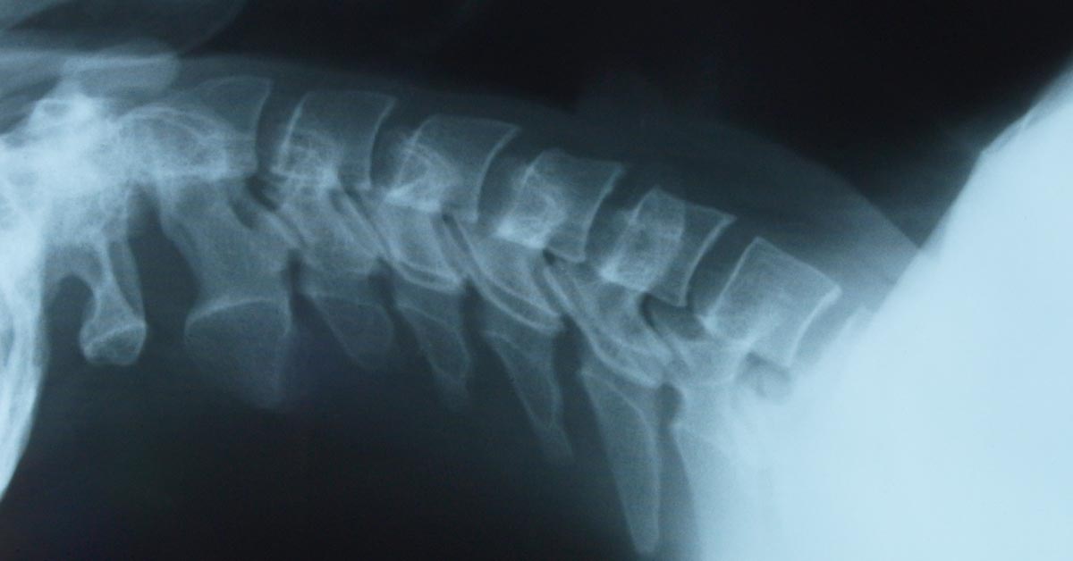 Olympia Back Pain Treatment without Surgery