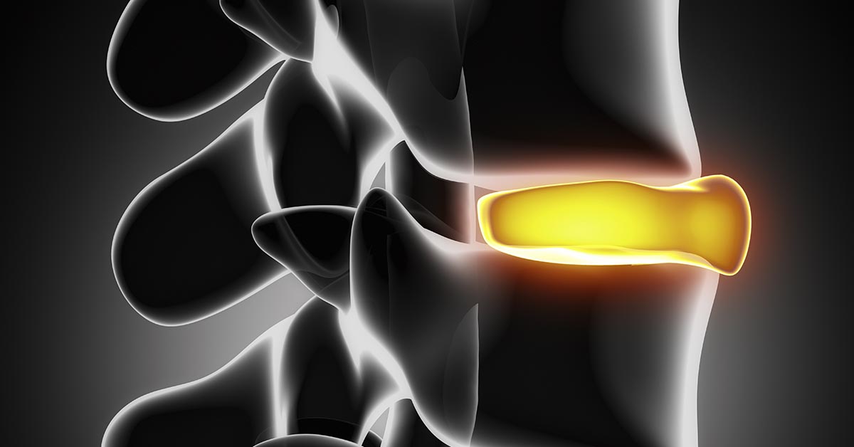 Otown chiropractic disc herniation treatment