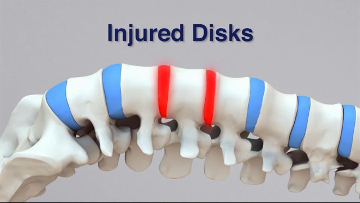Olympia non-surgical spinal decompression